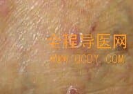 扁平苔癣  黑点癣
