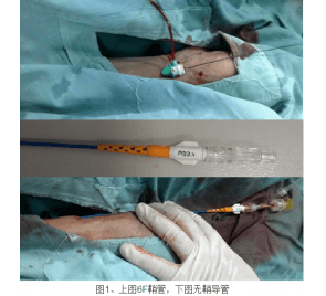 徐医附院开展无鞘指引导管及药物洗脱球囊两项新技术