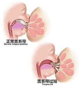 婴儿吃母乳总漏奶原是“大舌头”作祟 出生满月后治疗最佳