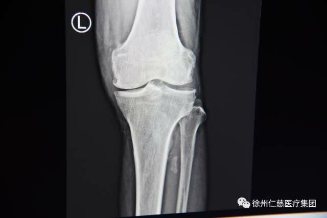 骨性关节炎要做关节置换？徐州仁慈医院微创截骨摆脱疼痛