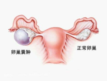 卵巢囊肿可保留卵巢功能微创治疗 术后需定时复查以防复发
