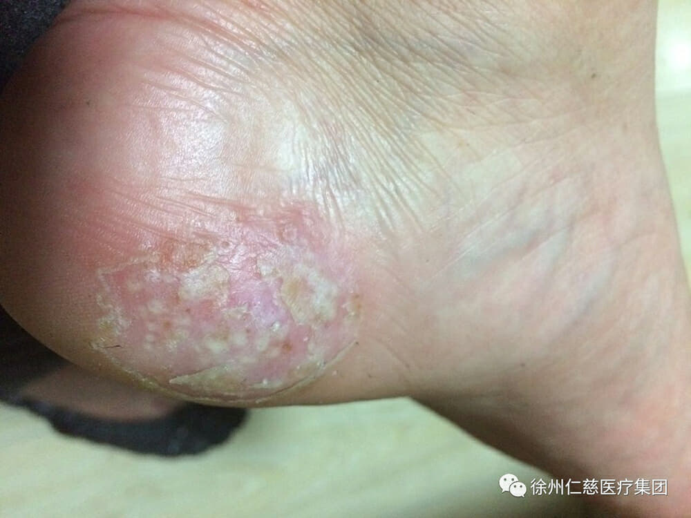 仁慈医院王娜:警惕脚上长"水疱 有可能是皮肤病