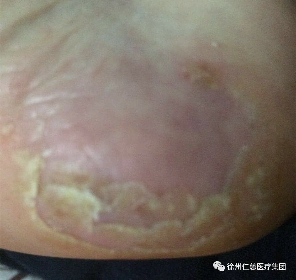 仁慈医院王娜:警惕脚上长"水疱 有可能是皮肤病