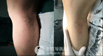 舞蹈老师腿上长满“蜘蛛网”,问哪家医院可治疗毛细血管扩张?