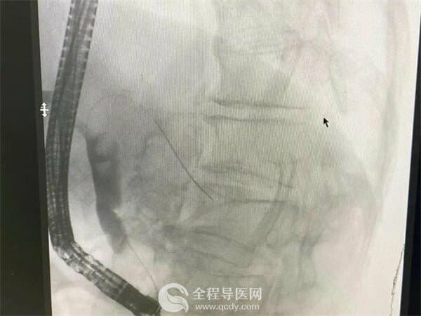 九旬老人腹痛发热难忍 徐州市一院运用新术式成功取石