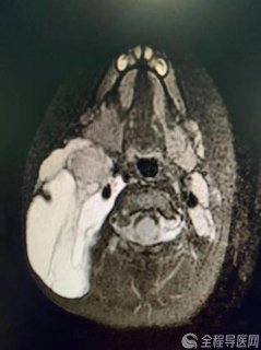 1岁女婴颈部长出芒果大的淋巴管瘤,医生巧用微创技术“拆弹”