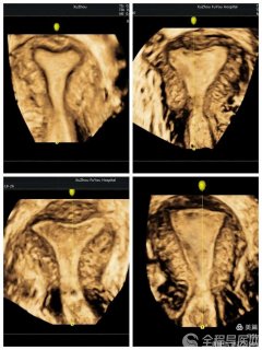 妇科超声利器！超声医学科专家：经阴道三维彩超 精准诊断妇科疾病