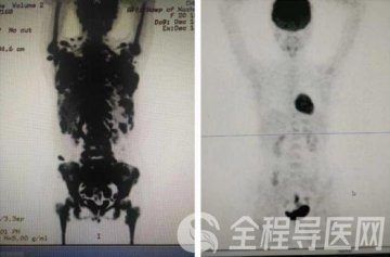 9.15国际淋巴瘤日 徐医附院CAR-T细胞治疗淋巴瘤效果显著