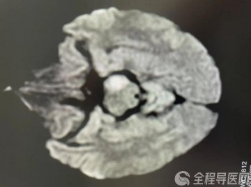 徐医附院援睢宁专家成功救治急性脑梗死患者