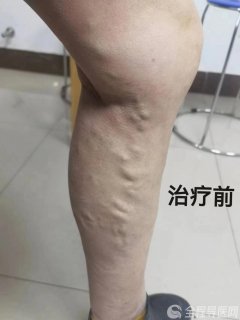 徐州市中医院治未病科:刺络放血治疗下肢静脉曲张,告别“蚯蚓腿”