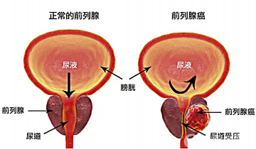 市中心医院泌尿外科庞昆:前列腺癌确诊利器—经会阴超声引导下前列腺穿刺活检术