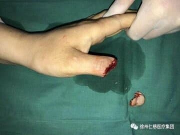 女工两根手指被打进34根钢针徐州仁慈医院抽丝剥茧手术取出异物