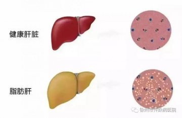 徐州市传染病医院肝病专家科普:与脂肪肝相关的几个误区