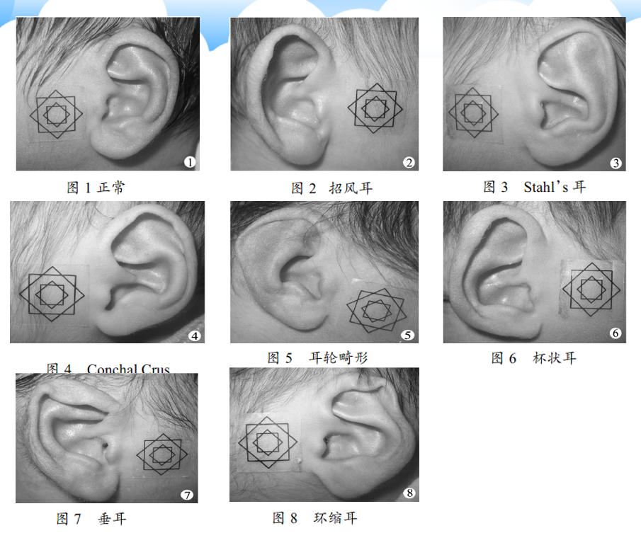 唐氏儿的耳朵特征图片