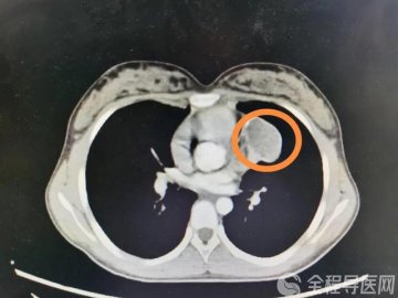 13岁女孩胸痛咳嗽 徐州市儿童医院手术取出鸡蛋大的胸腔畸胎瘤