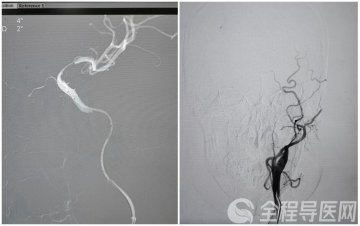 疫情下的温情| 徐医附院精准施治 挽救脑卒中患者于危难