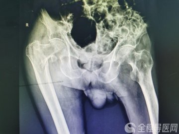 百岁老人髋关节骨折 徐医附院骨科挑战超高龄禁区 成功实施微创手术