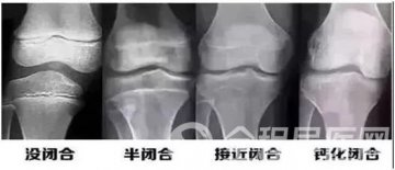 AI免费测骨龄 徐矿总医院内分泌科8月28日上午将开展儿童生长发育义诊