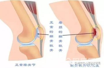 徐州骨科博士冯仕明:腿发软、关节疼 警惕髌骨软化症
