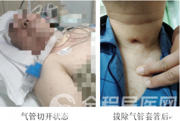 徐州市康复医院帮助一例神经重症气管切开患者顺利拔管并恢复行走