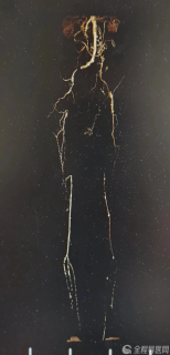 老人右脚溃烂坏疽 徐矿总医院实施腔内介入结合外科开放手术免被截肢