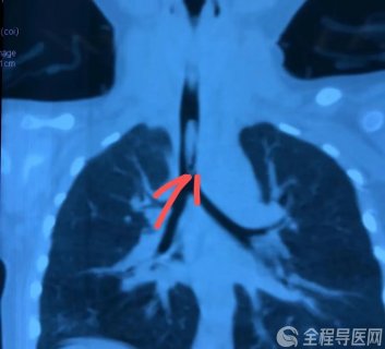 1岁9月因吃葵花子被卡住 徐州儿童医院接诊多起气管异物~