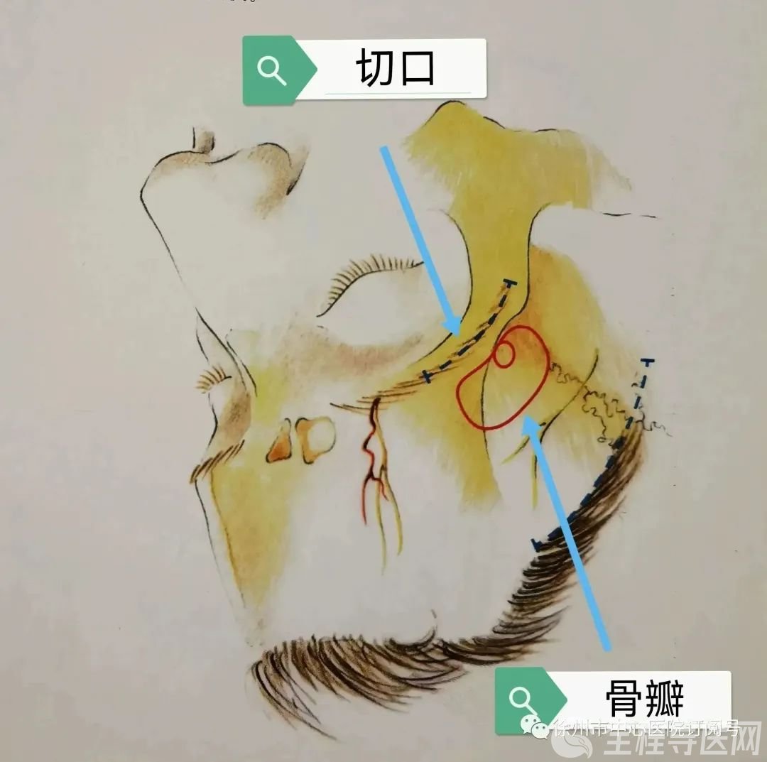 颅颈交界畸形系列（二）小脑扁桃体下疝脊髓空洞 - 微医（挂号网）