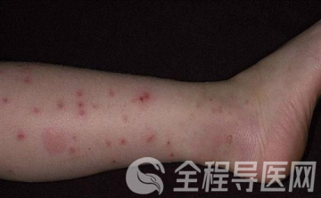 徐州市儿童医院皮肤科尹瑞瑞:春季谨防儿童丘疹性荨麻疹
