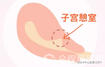 生完孩子月经淋漓不尽 中心医院妇产科杨新慧谈子宫瘢痕憩室