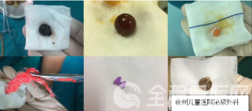 徐州市儿童医院泌尿外科:儿童泌尿生殖系统异物怎么办?