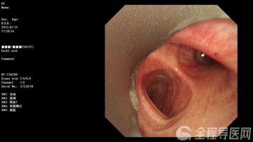 徐医附院呼吸内镜中心完成第一例硬镜下肿瘤消融术