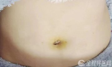 徐州一院生殖医学中心周彩霞：单孔腹腔镜手术，让您完美“炫腹”