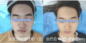 徐州市中心医院皮肤科李晶冰为大家解析什么是刷酸