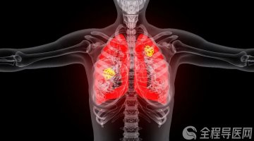 结节、息肉是不是癌?要不要治?专家为你科普