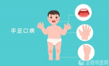 什么是手足口病？日常如何预防手足口病？