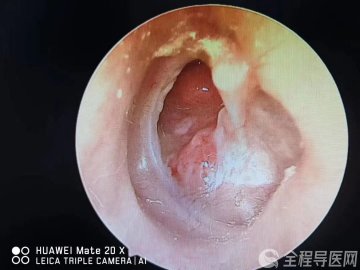徐州一院耳鼻咽喉科微创耳内镜下鼓室成形术让他摆脱35年的助听器
