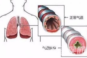 气道堵得只剩一条缝 徐矿总医院呼吸与危重症医学科微创治疗良性气道狭窄