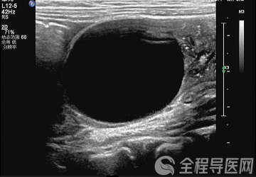 儿童吞食“泡大豆”致肠梗阻,徐州市儿童医院