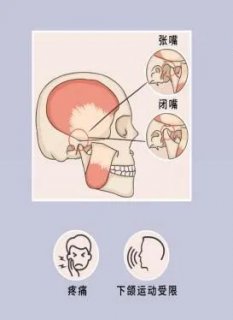 徐州市中心医院理疗科:颞下颌关节疼痛,无痛针灸快速止痛