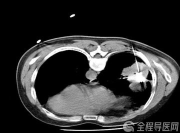 徐州市中医院微波消融术微微创治疗肺癌 简便、高效、精准