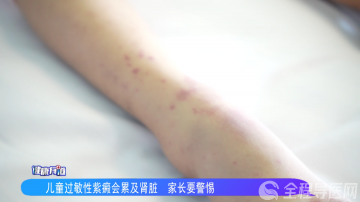 徐州市儿童医院科普：儿童过敏性紫癜会累及肾脏 家长要警惕！