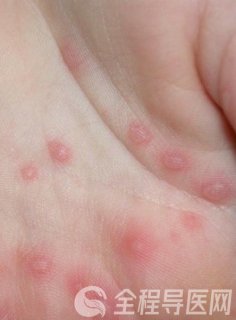 徐州疾控提醒:手足口病多见于4-9月,出现这些症状要警惕