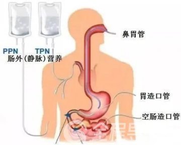 徐州一院重症医学科：营养治疗的重要性，你了解吗？