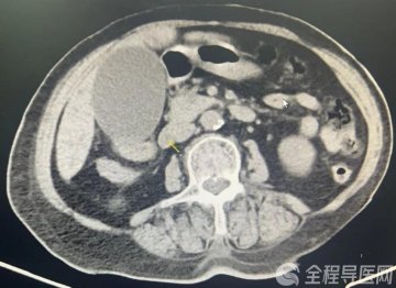 百岁老人巨大结石引起黄疸 徐医附院消化内科超级微创ERCP术迅速减黄获点赞