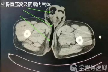 徐州市中医院肛肠科秦晓静:准确识别肛周坏死性筋膜炎 延误治疗可危及生命