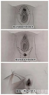 老人外阴瘙痒 私处小疙瘩竟是外阴癌 徐州妇幼保健院根治性手术治疗