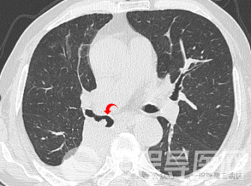 徐州一院实施支气管镜下冷冻技术 成功改善晚期肺癌患者腔内狭窄