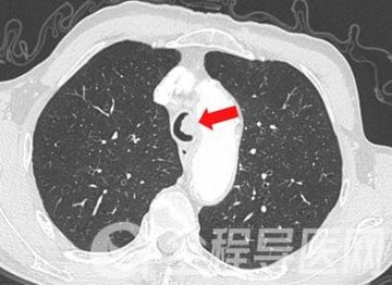 更精准、更微创——徐州一院支气管镜下介入治疗技术取得新突破