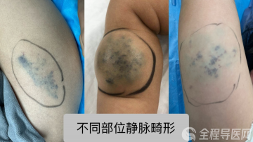 徐州市儿童医院科普:儿童静脉畸形的病因、症状及治疗