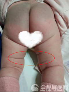 婴幼儿腿纹不对称？徐州儿科专家：警惕发育性髋关节发育不良